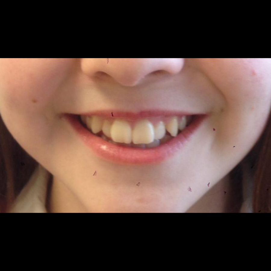 Teenage Braces - Costs and Other Questions - kids braces - before - 3Dental